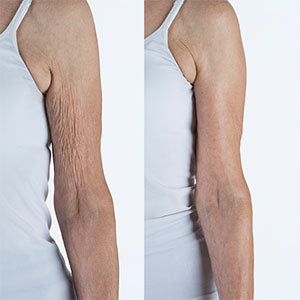 How To Get Rid Of Saggy Arms The Bodyfirm 